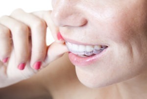 Perfekte Zähne sind in Markt für Zahnkorrekturen boomt